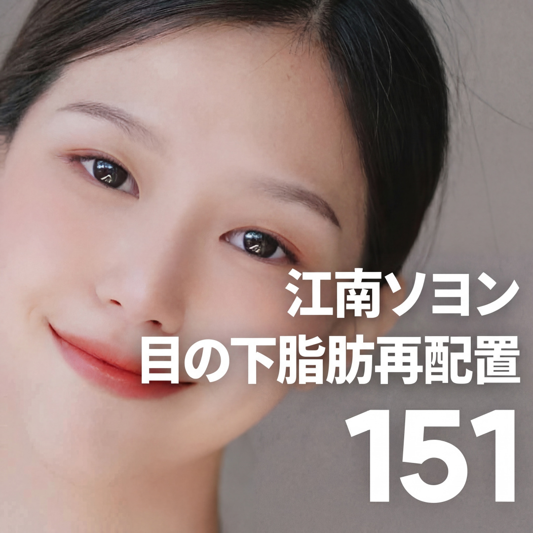 Gangnam Seoyeon Tái phân bố mỡ dưới mắt