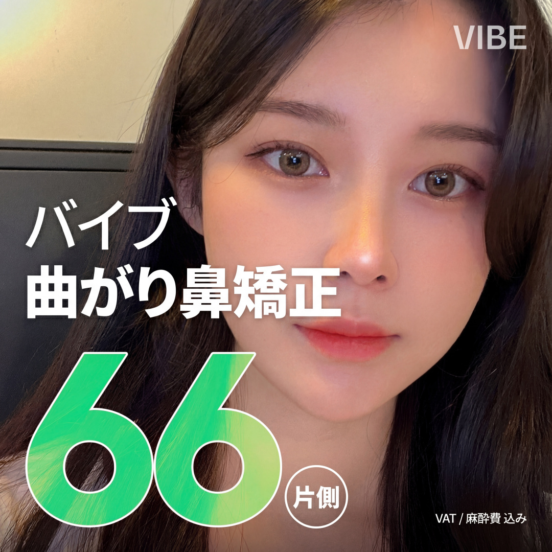 VIBE Chỉnh mũi hếch - Hạ viền mũi - Chỉnh đầu mũi - Chỉnh lỗ mũi lệch