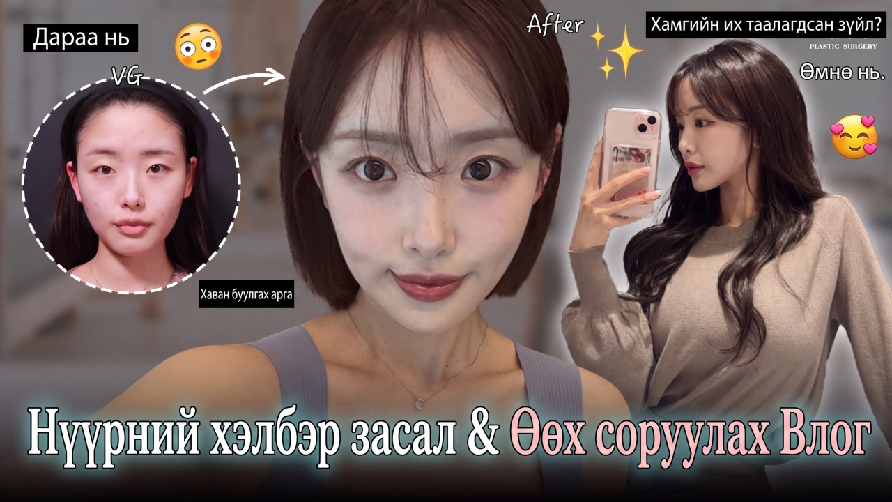 Нүүрний хэлбэр засах 3 төрөл & Өөх соруулах мэс заслын бодит түүх VLOG✨ I Мэс заслын түүх I VLOG I Нүүрний хэлбэр засах I Хэвлийн өөх соруулах I