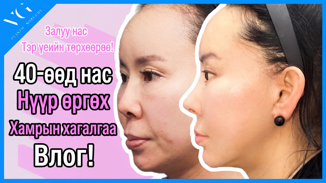 Арьс татах мэс заслаар залуу насаа эргүүлэн авлаа! l Нүүр татах мэс заслын 3 сарын дараах бодит сэтгэгдэл