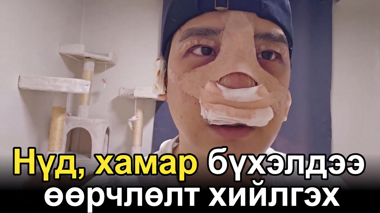 Эрэгтэй хүн гоо сайхны мэс засал хийлгэвэл ингэж өөрчлөгдөнө ｜ Нүд · Хамрын мэс засал