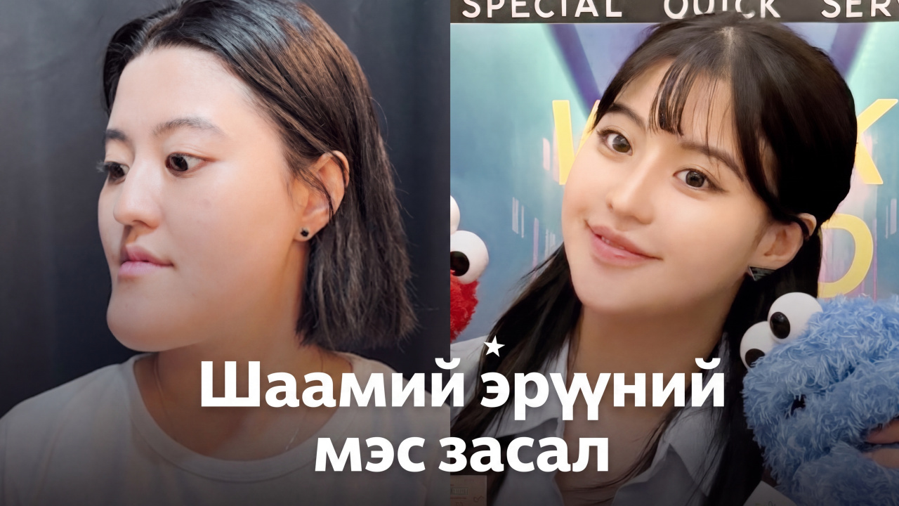 Шаамий эрүүний мэс заслын дараах амьдралын 2 дахь үе эхэллээ | Girin гоо сайхны эмнэлэг